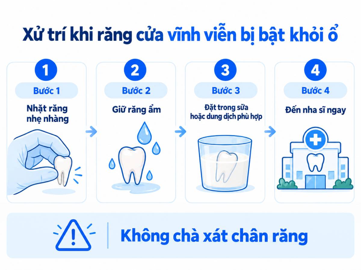 Răng cửa vĩnh viễn bị bật khỏi ổ là tình huống cần được xử trí sớm; cách bảo quản răng trước khi đến nha sĩ có ý nghĩa quan trọng.